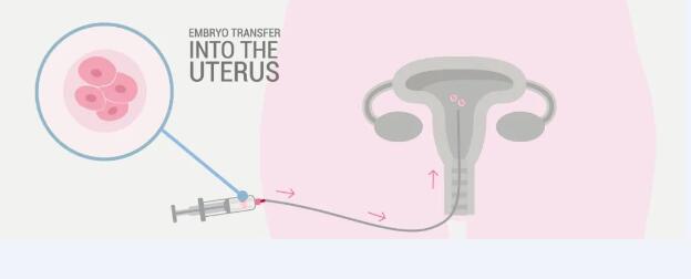 冷冻胚胎移植方案主要有四种