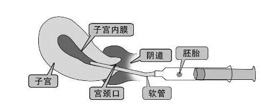 试管移植全部流程（试管移植全过程详解）